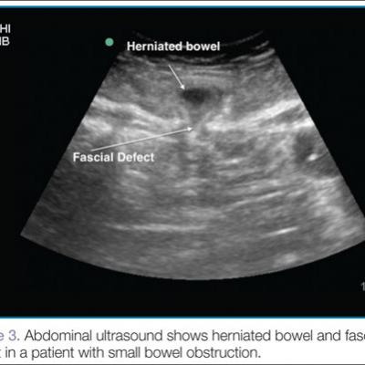 Emergency Ultrasound: Bedside Ultrasound To Diagnose Small Bowel ...