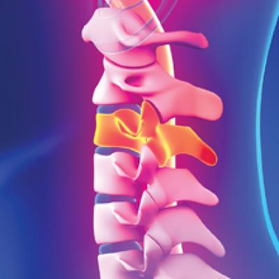 Nontraumatic Disc Herniation as a Cause of Unusual Cervical Spondylotic ...