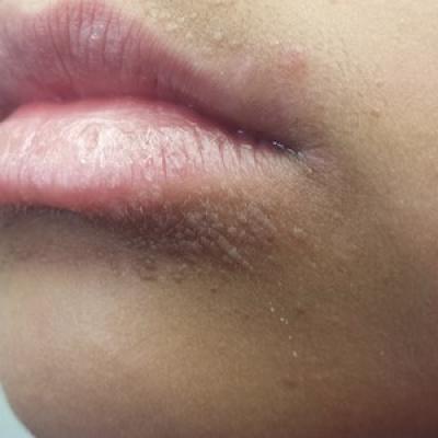 Bumps on lips little Bumps On