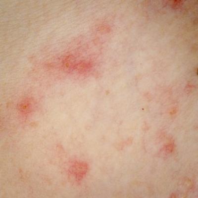 Childhood eczema takes financial, emotional toll on families | MDedge ...