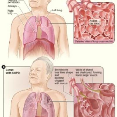 Antibiotic Prophylaxis for COPD | MDedge