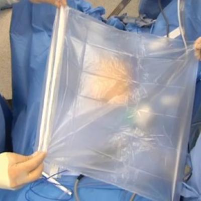 EZCATCH Tissue Retrieval Bag - Pack of 5 - Hospitalbuy