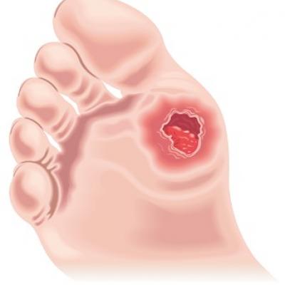 cellulitis bottom of foot