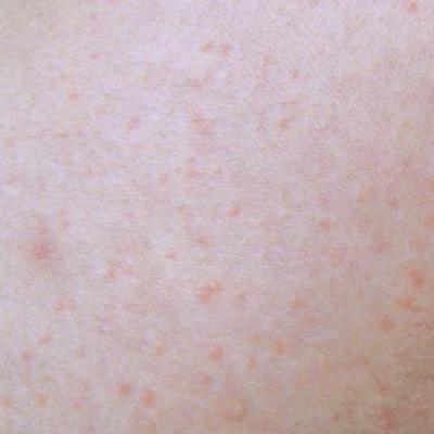 New urticaria guidelines stress simplicity | Clinician Reviews