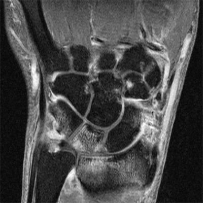 MRI detects high level of subclinical small joint inflammation | MDedge ...