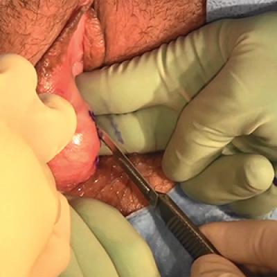 How long does it take a bartholin cyst to drain Excision Of A Bartholin Gland Cyst Mdedge Obgyn