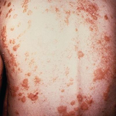 No evidence of subclinical axial involvement seen in skin psoriasis ...