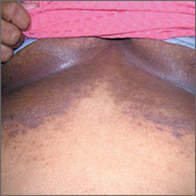 Dark rash under breasts