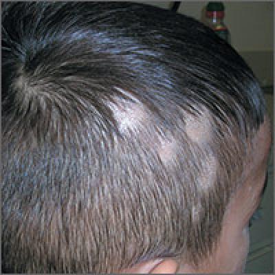 Hair Loss On Scalp Mdedge Family Medicine