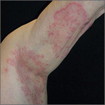 Pruritic rash on trunk  MDedge Family Medicine