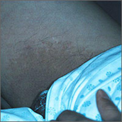 Woman with rash in groin