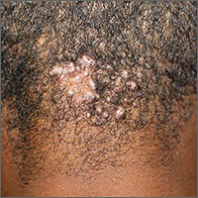 Scalp papules in a teenage boy | MDedge Family Medicine