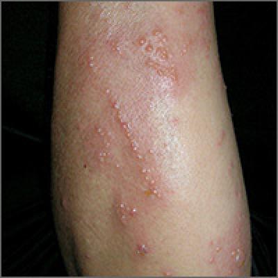 Intensely pruritic rash | MDedge Family Medicine