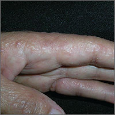 Itchy Rash On Sides Of Fingers Mdedge Family Medicine