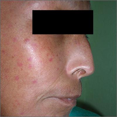 Help! My Skin Was Pulled Too Tight After a Facelift- DrKolstad - San  Diego Facial Plastic Surgeon