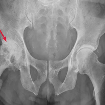 Right hip and pelvic pain | MDedge Family Medicine