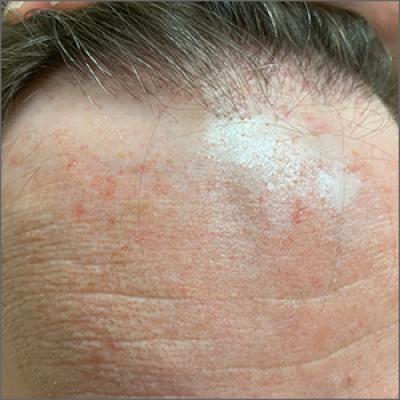 Receding hairline | MDedge Family Medicine