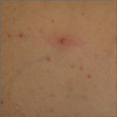 Papules on a child’s chest | MDedge Family Medicine