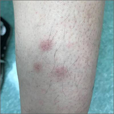 Recurrent leg lesions | MDedge Family Medicine