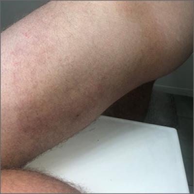 Large circular thigh rash