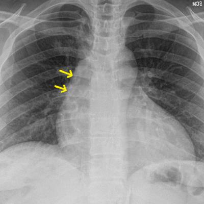20-year-old man • sudden-onset chest pain • worsening pain with cough ...
