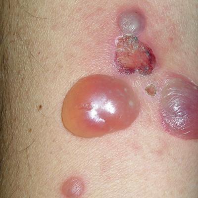 pruritic blisters and bullous lesions_Psoriasis_Types_Symptomes_Treatment_Dr-Qaisar_Ahmed-Dixe_Cosmetics