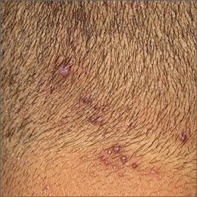 Neck papules in a young man | MDedge Family Medicine