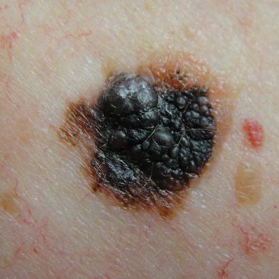 Melanoma: An FP’s guide to diagnosis and management | MDedge Family ...