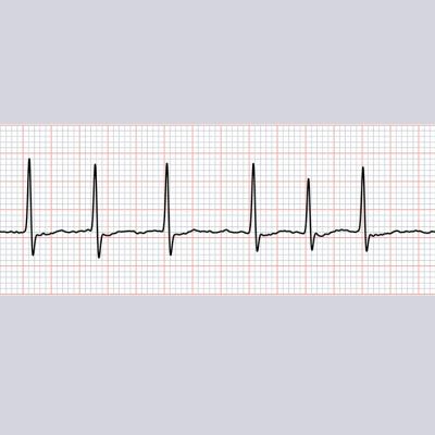 Monotherapy for nonvalvular A-fib with stable CAD? | MDedge Family Medicine