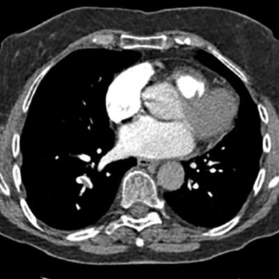 75-year-old woman • right-side rib pain • radiating shoulder pain ...