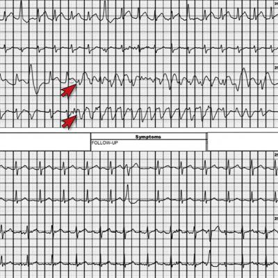 52-year-old man • syncopal episode • chest pain • mild lightheadedness ...