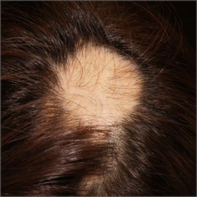 Focal hair loss | MDedge Family Medicine