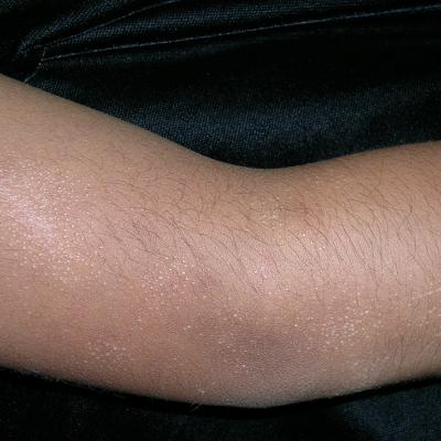 Coalescing skin-colored papules | MDedge Family Medicine