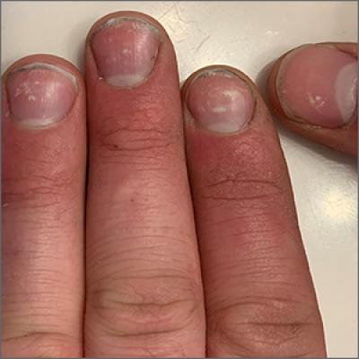 Spotted white fingernails | MDedge Family Medicine