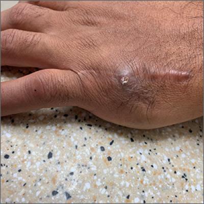 Recurrent drainage from an old gunshot wound MDedge Family Medicine