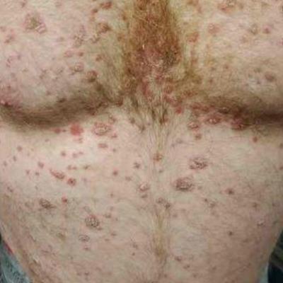 Severe rash after COVID-19 vaccination