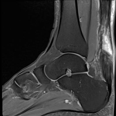 Acute Achilles tendon rupture: Skip the surgery? | MDedge Family Medicine