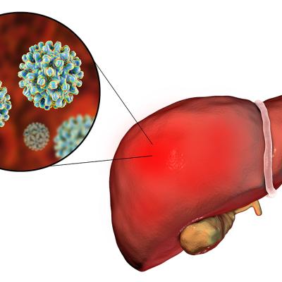 Screening For Hepatitis B: Where The CDC And USPSTF Diverge | MDedge ...