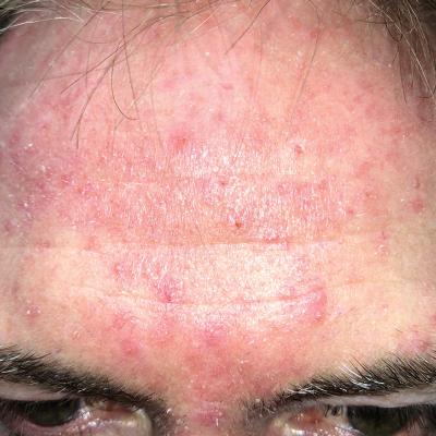 Not acne, but what? | MDedge Family Medicine