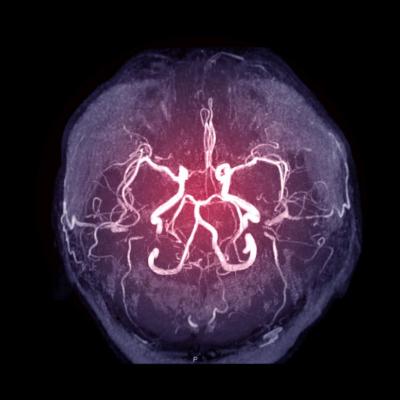 Intracranial atherosclerosis finding on MRA linked to stroke | MDedge ...