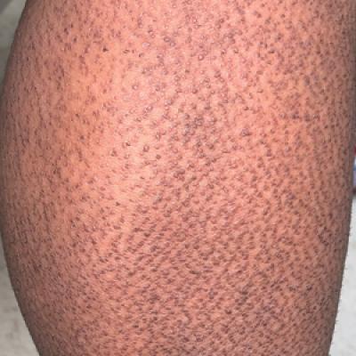 Rippled Macules and Papules on the Legs