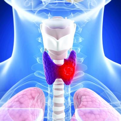 In low-risk thyroid cancer, no advantage found for postsurgical iodine ...