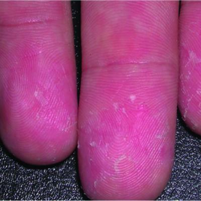 Watch for cutaneous manifestations of tropical infectious diseases ...