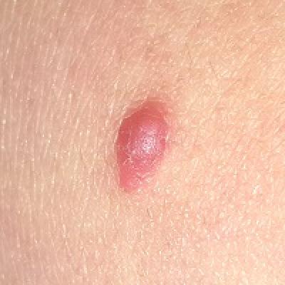 Wart's That Lesion? | Clinician Reviews