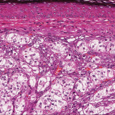 Red-Blue Nodule on the Scalp | MDedge Dermatology