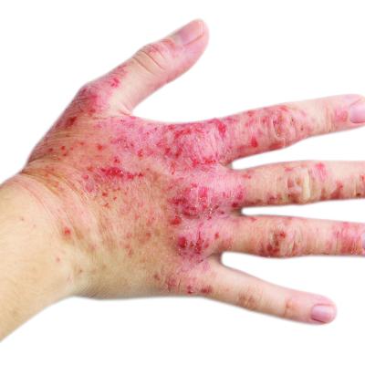 Facial, hand, and foot dermatitis: Lebrikizumab and dupilumab show ...