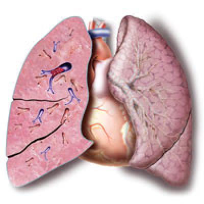 Malpractice Counsel: Acute Pulmonary Embolism Masquerading as Acute ...