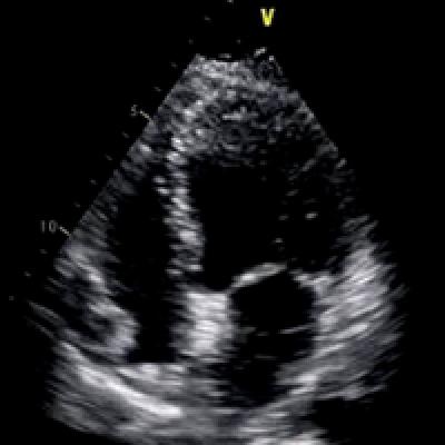 Bedside Cardiac Ultrasound to Aid in Diagnosing Takotsubo ...