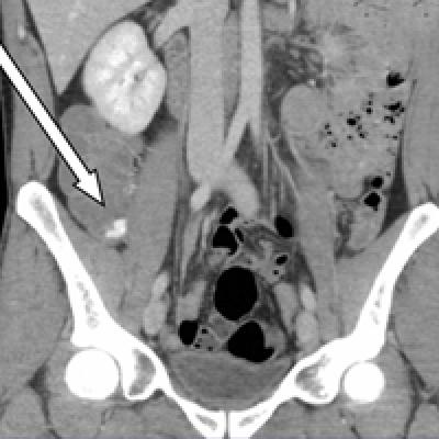 Diagnosis of Severe Acute Lower Gastrointestinal Bleeding with CTA ...