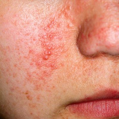 If it’s not acne, warts, or molluscum ­contagiosum, what is this ...